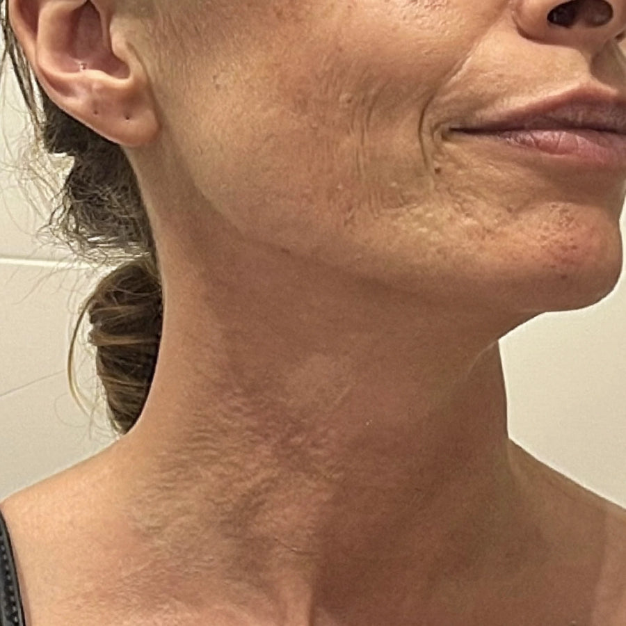 Melissa's neck skincare result